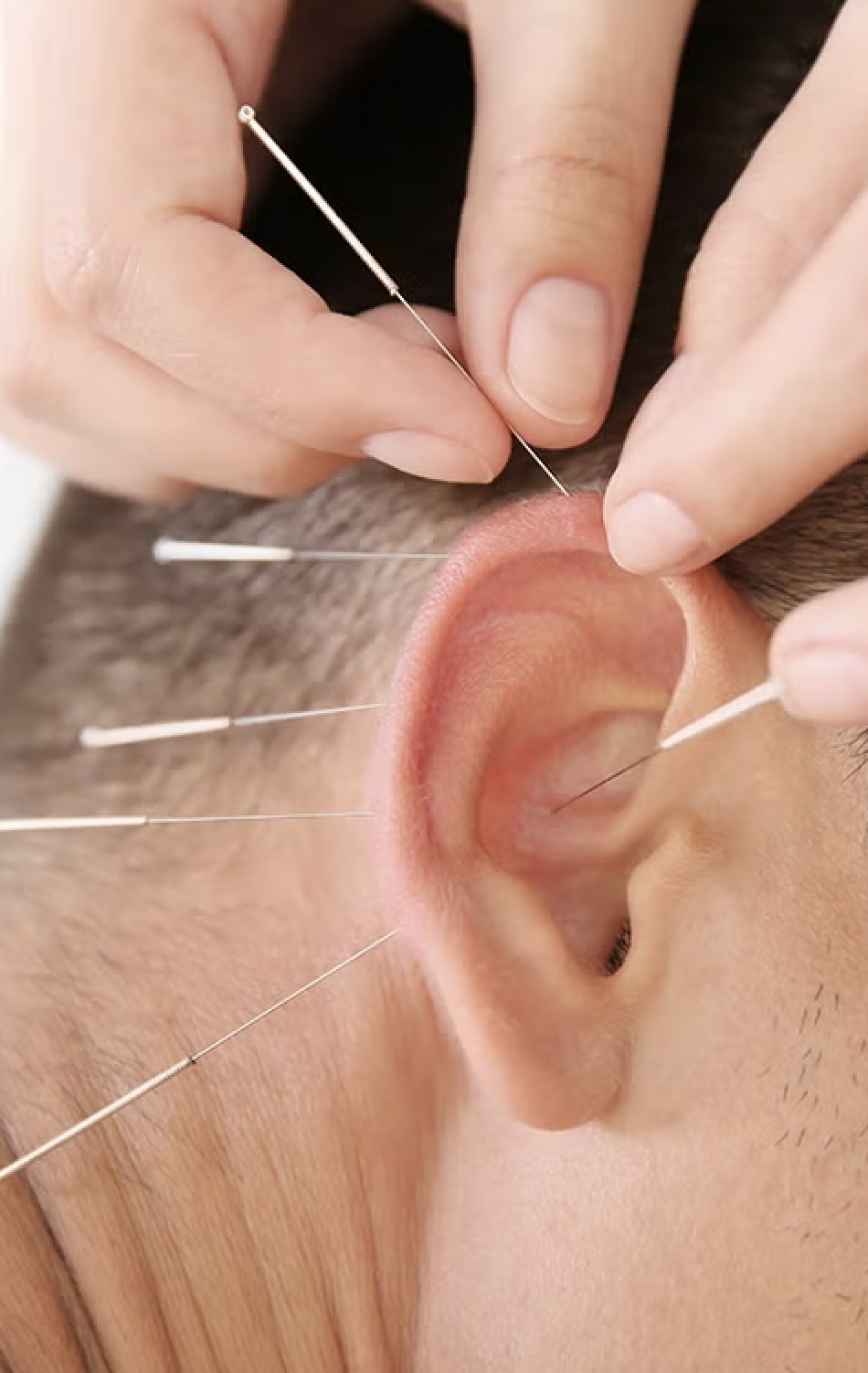 Akupunktør setter tynne nåler i øret på pasient som får øreakupunktur, et kurs ved Institutt for Helhetsmedisin for terapeuter som vil lære auriculoterapi og ørets soner.
