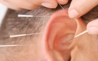 Øreakupunktur – presis behandling av ørets soner Akupunktør setter tynne nåler i øret på pasient som får øreakupunktur, et kurs ved Institutt for Helhetsmedisin for terapeuter som vil lære auriculoterapi og ørets soner.